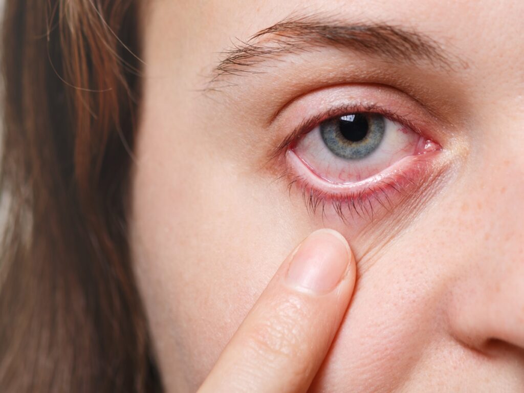 Medicine, health care and eyesight concept. Unrecognizable female shows her inflated red eye with blood capillary, has conjuctivitis. Woman with injured eye